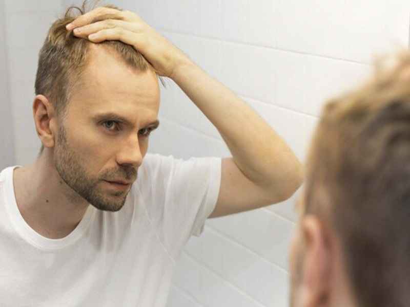 تأثیر مکمل های ورزشی بر ریزش مو